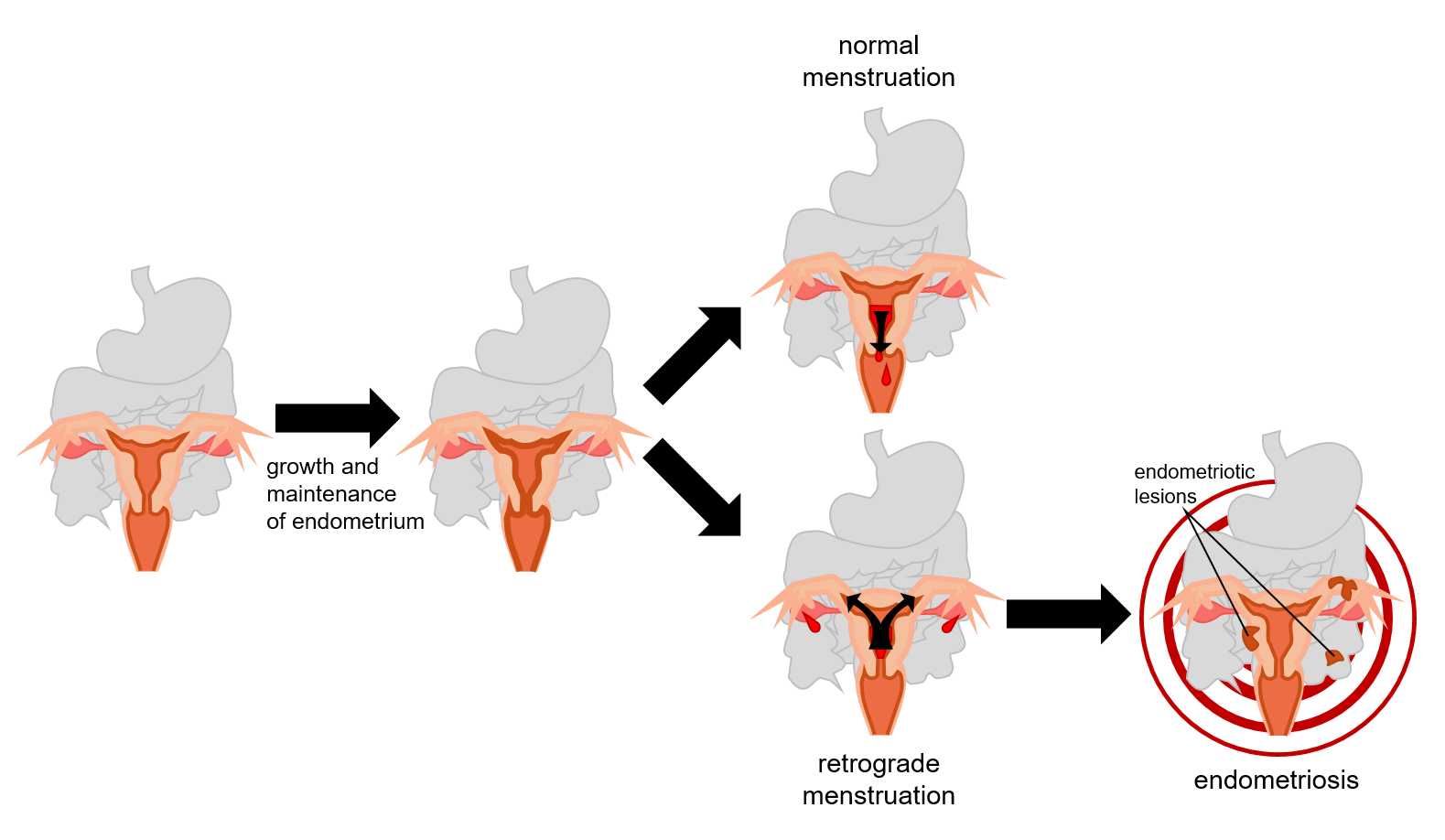 Retrograde uterus and constipation